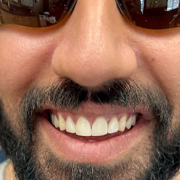 After composite veneers