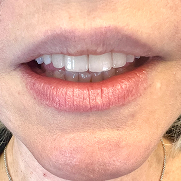 After porcelain crowns treatment