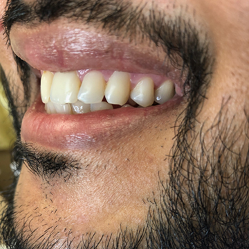 After smile transformation 04